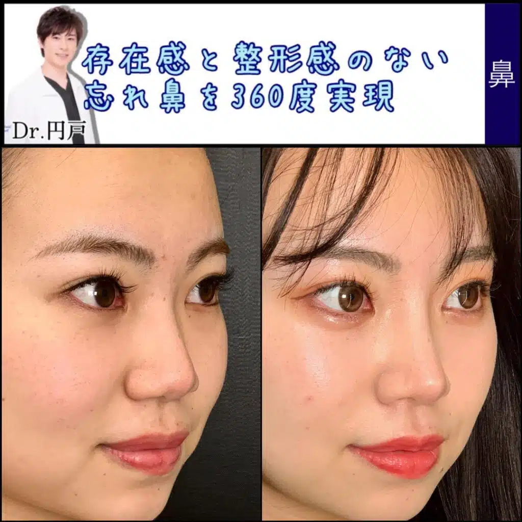 小鼻縮小 福岡