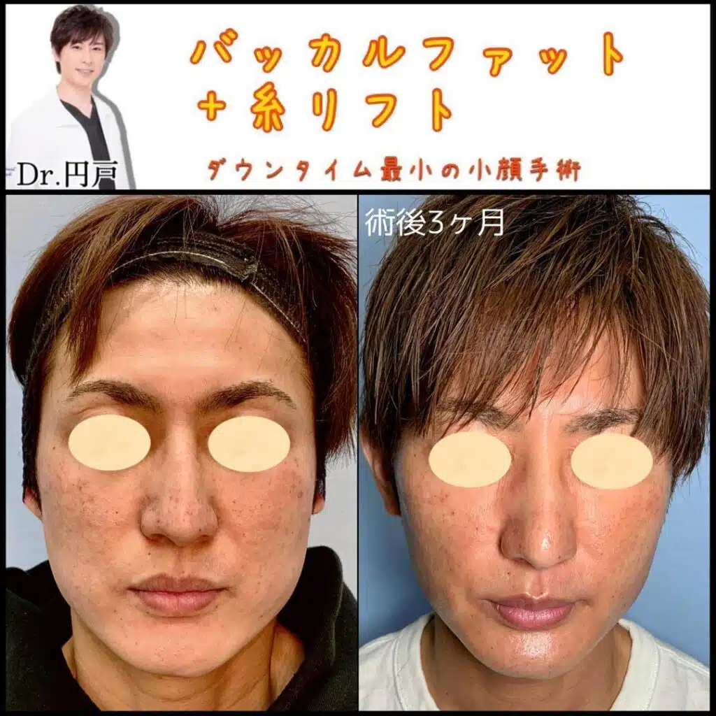 バッカルファット+糸リフト 福岡