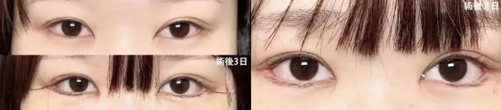 白目の露出を広げるデザイン 福岡