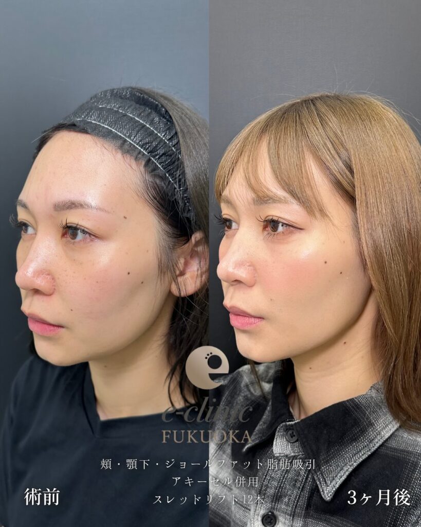 小顔脂肪吸引とジョールファットと糸リフトの症例写真（名医のeクリニック伊藤渉医師が執刀）