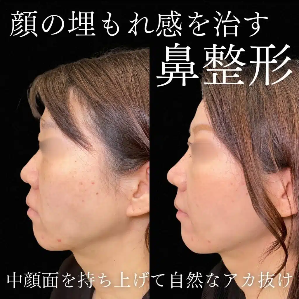 鼻尖形成 福岡
