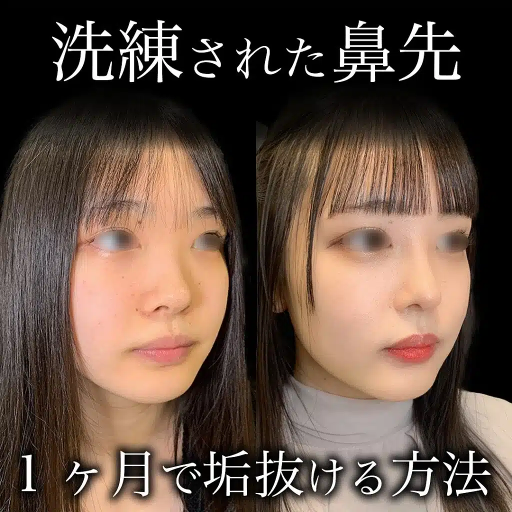 鼻の耳介軟骨移植 福岡