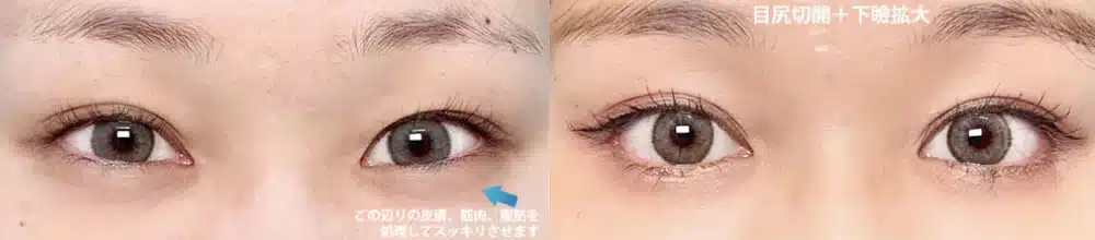 つり⽬を⾃然なアーモンド型に整えるデザイン 福岡
