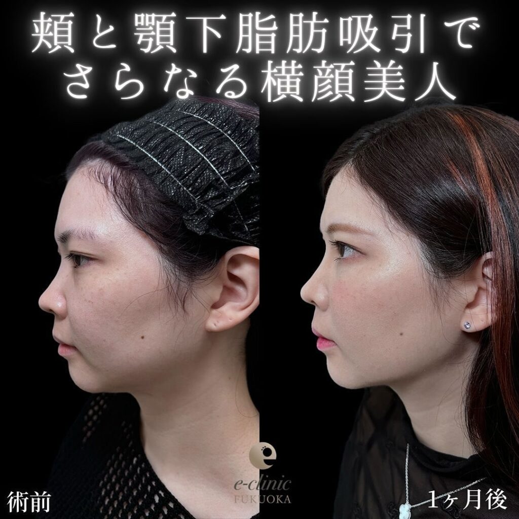 小顔脂肪吸引とジョールファットと糸リフトの症例写真 (9)