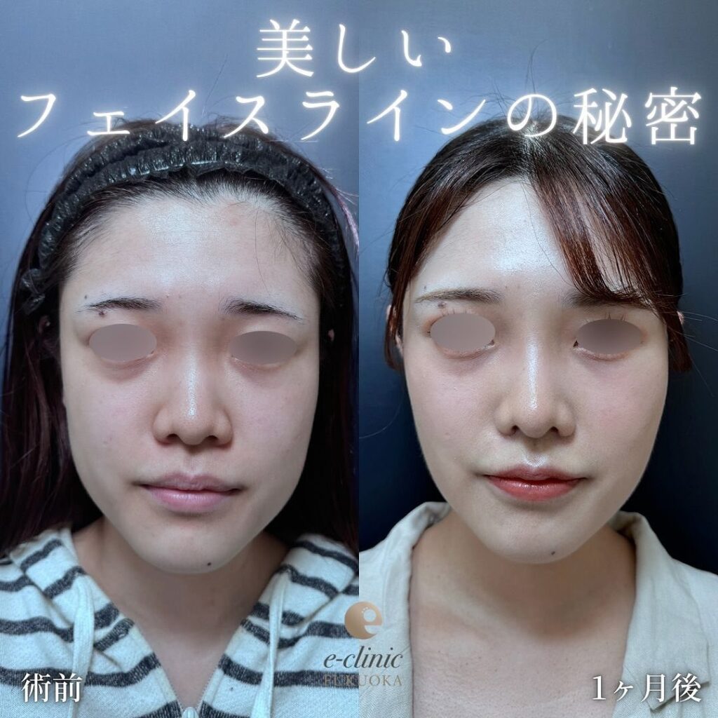 脂肪吸引と糸リフトとバッカルファットの症例写真 (1)