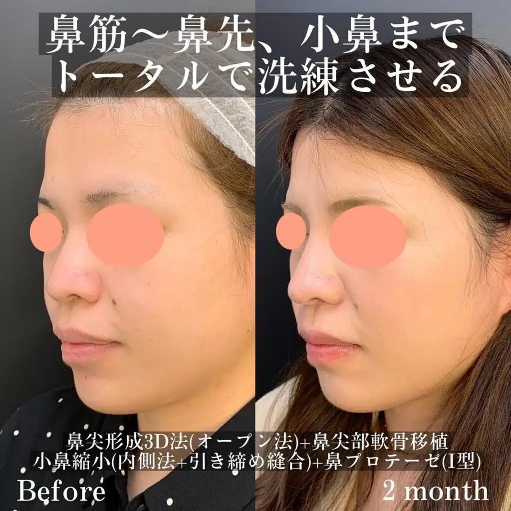 鼻尖形成3D法(オープン法)+鼻尖部軟骨移植+小鼻縮小(内側法+引き締め縫合)+鼻プロテーゼ(Ⅰ型) 福岡