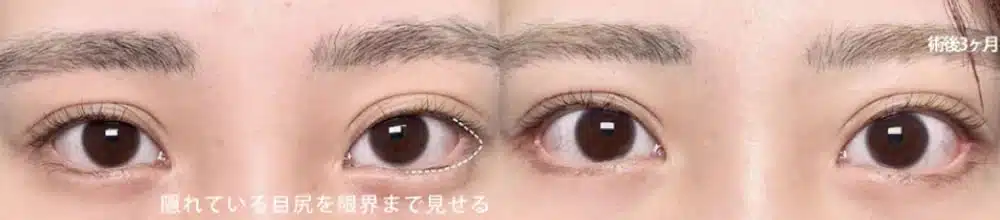 目尻側の白目の露出を増やすデザイン 福岡