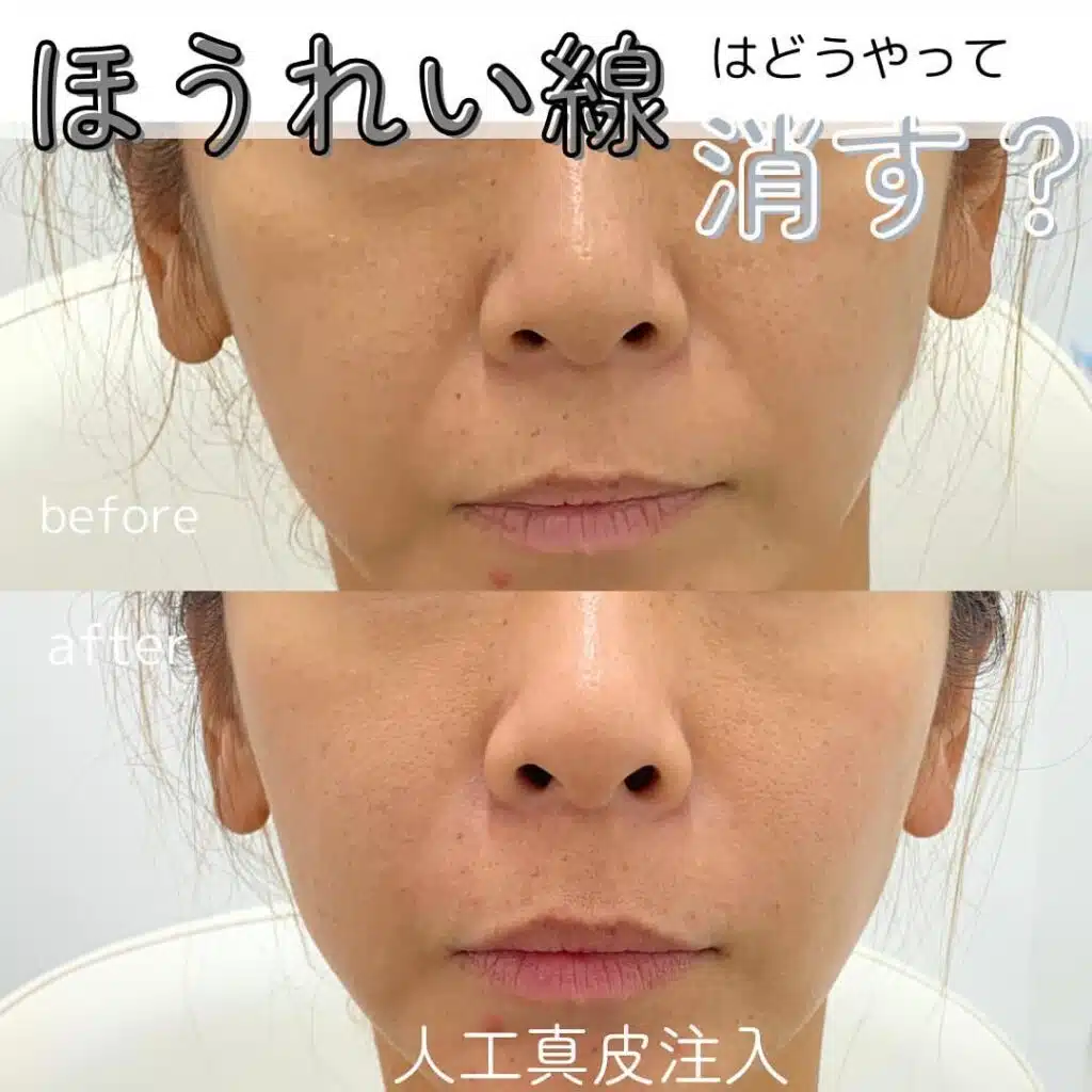 人工真皮注入 福岡