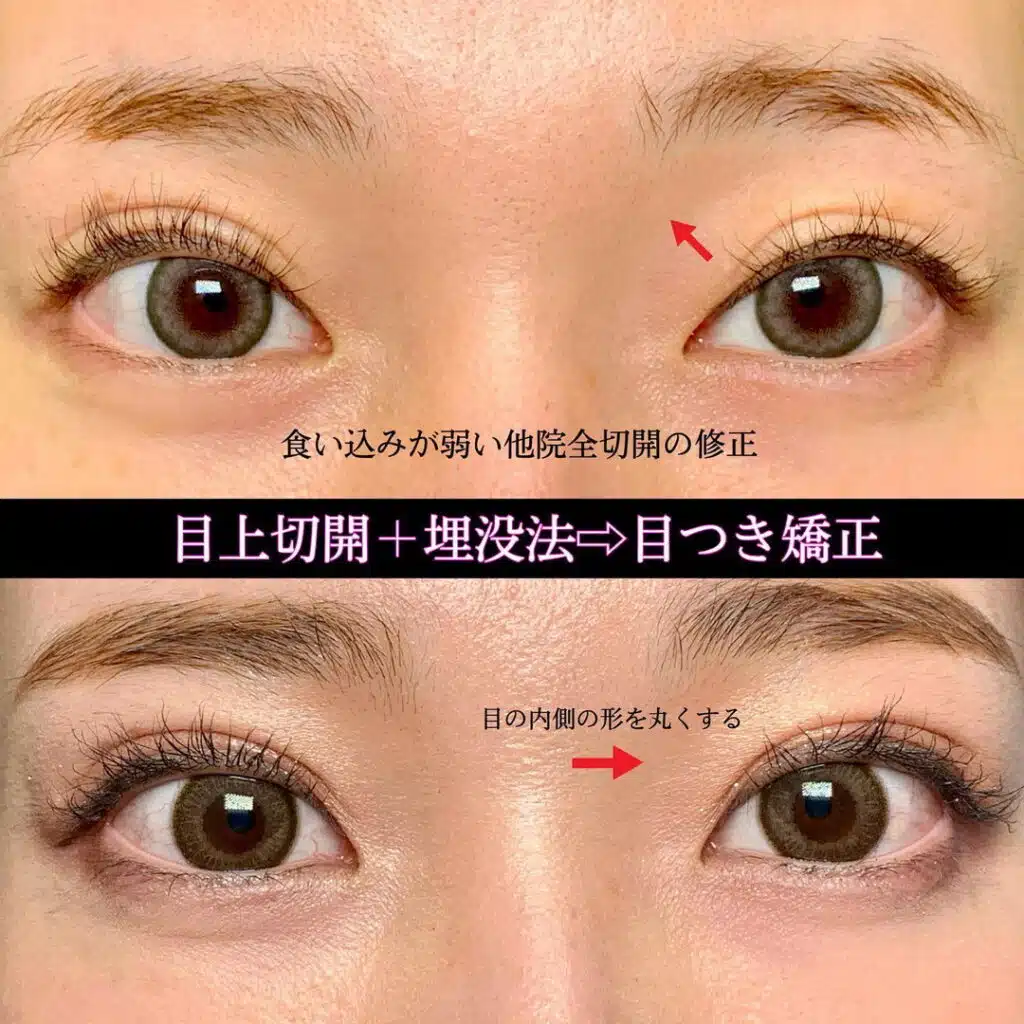 目上切開+埋没法　福岡