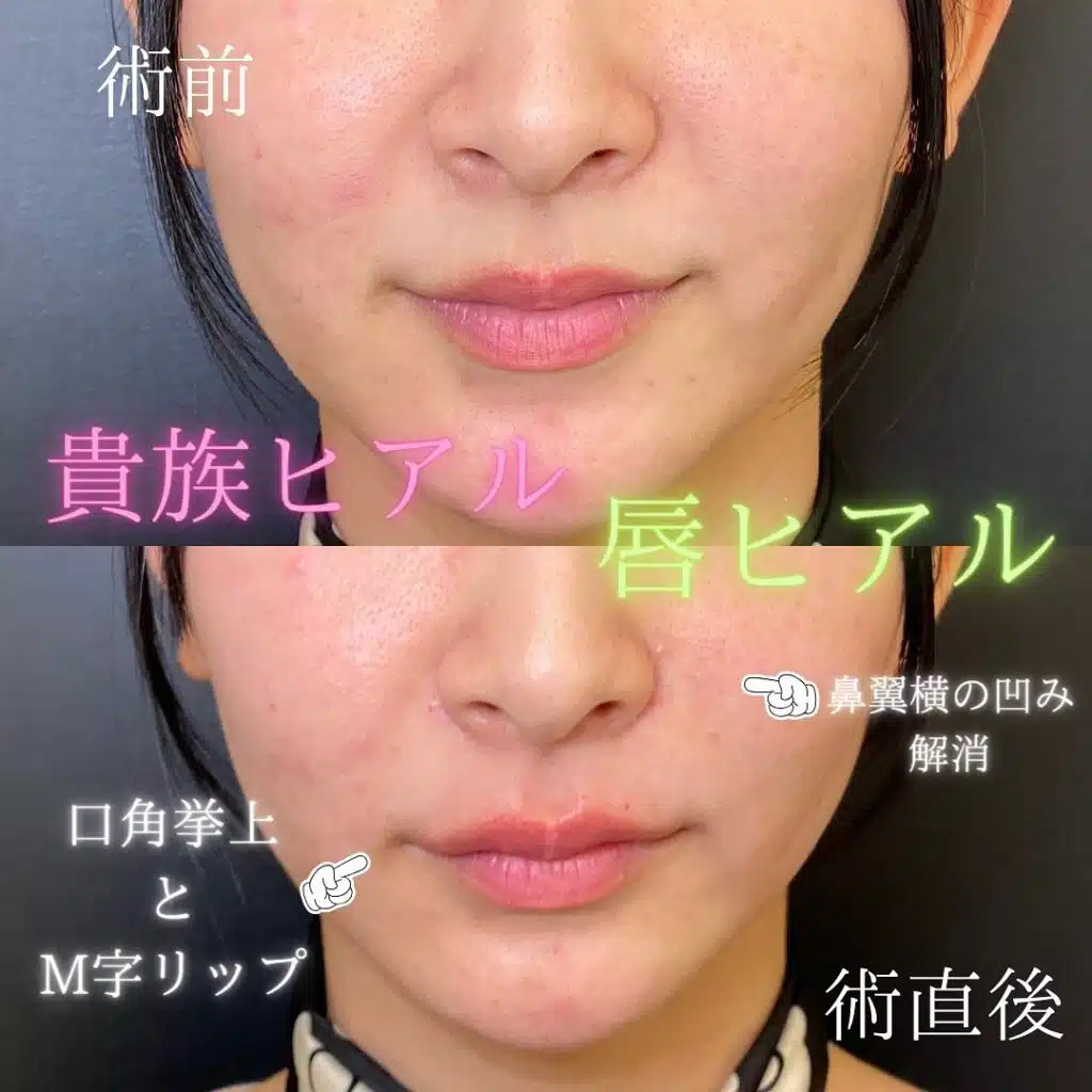 貴族ヒアルロン酸 福岡
