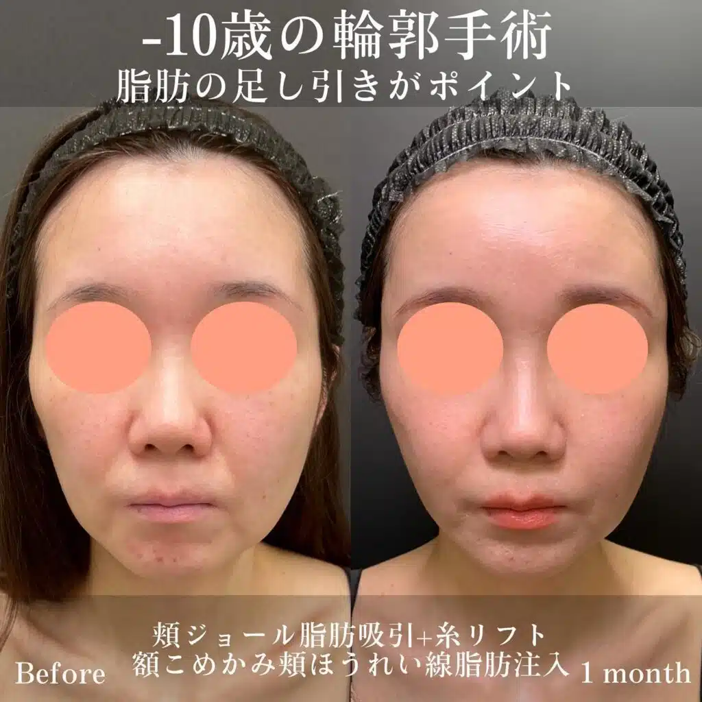 頬ジョール脂肪吸引+糸リフト 額こめかみ頬ほうれい線脂肪注入 福岡