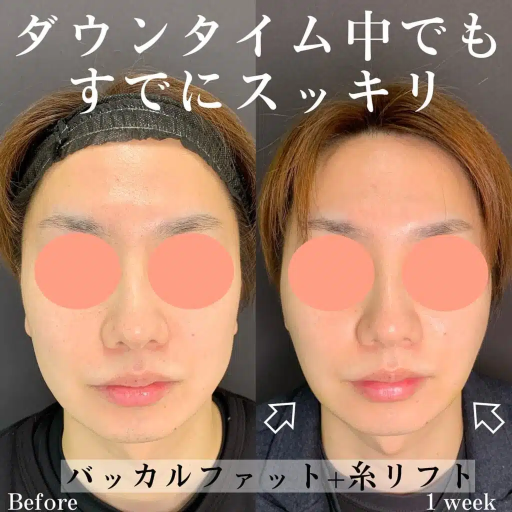 バッカルファット+糸リフト 福岡