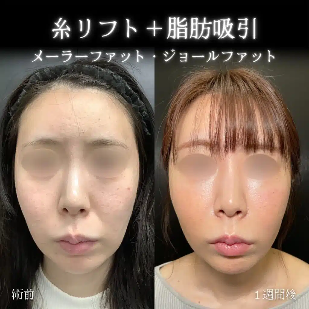 糸リフト＋脂肪吸引　福岡