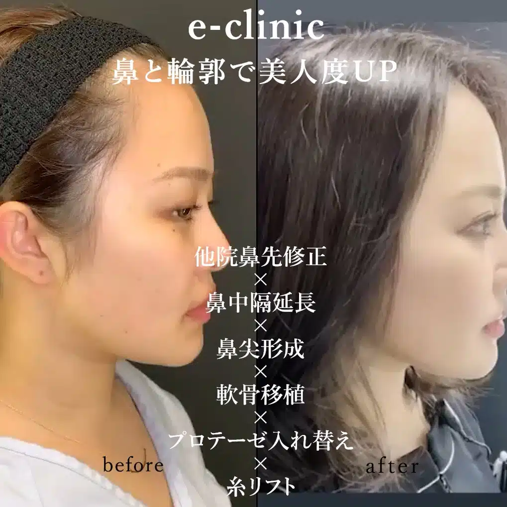 他院鼻先修正×鼻中隔延長×鼻尖形成×軟骨移植×プロテーゼ入れ替え×糸リフト 福岡