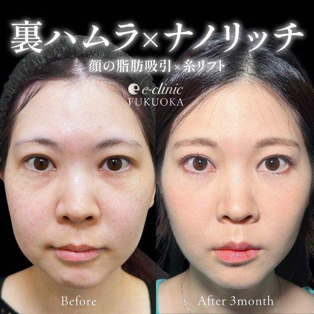 裏ハムラ法と脂肪注入の症例写真 (1)