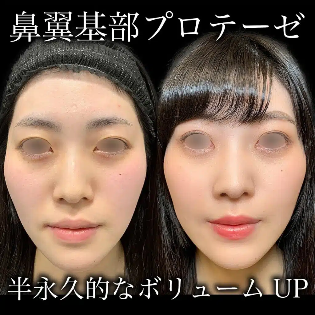 鼻翼基部プロテーゼ 福岡