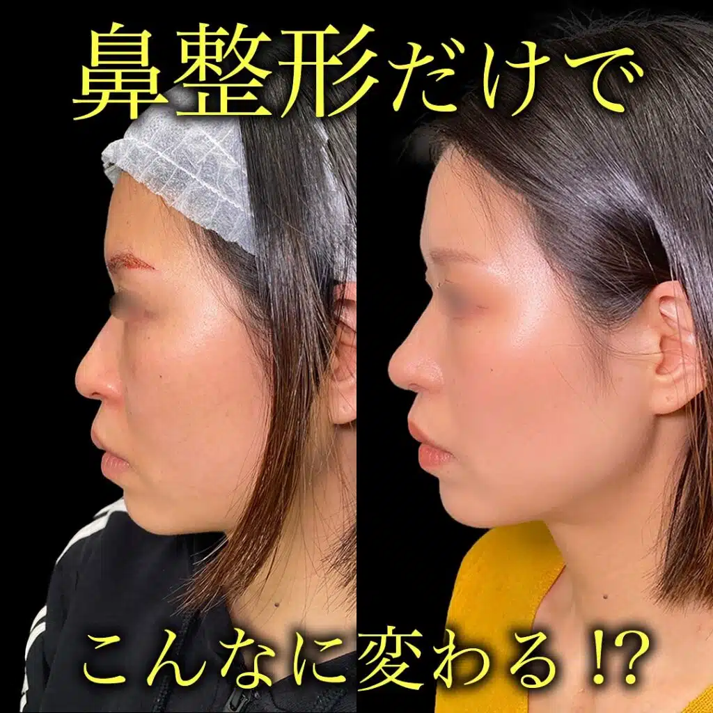 鼻尖形成と耳介軟骨移植と小鼻縮小 福岡