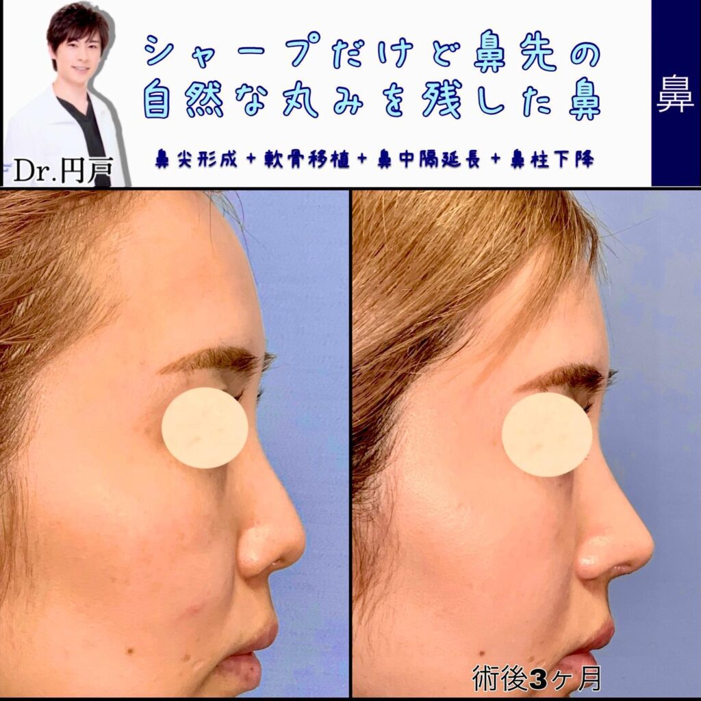鼻尖形成と軟骨移植と鼻中隔延長と鼻柱下降の症例写真