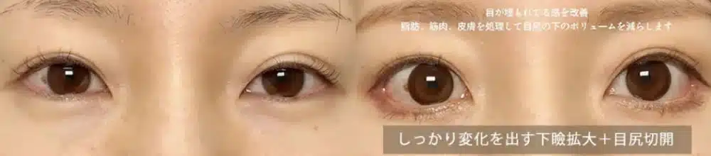 しっかり変化を出す下瞼拡大+目尻切開 福岡