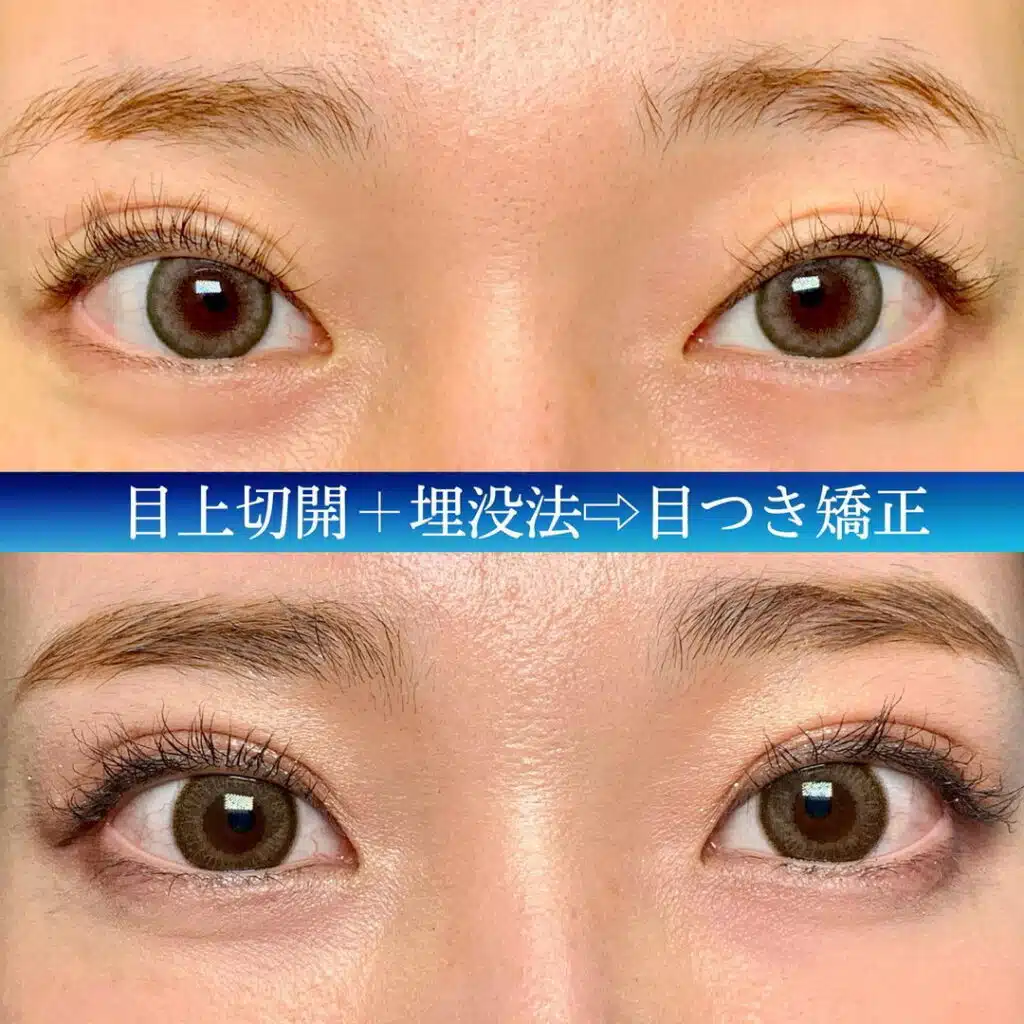 目上切開+埋没法　福岡