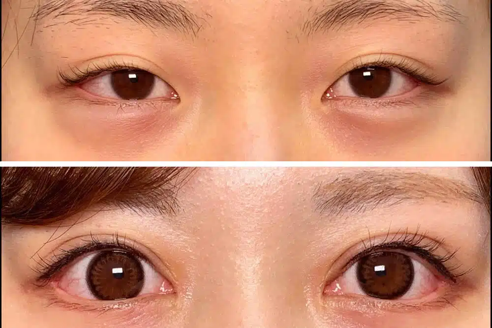 目尻切開＋目頭切開　福岡