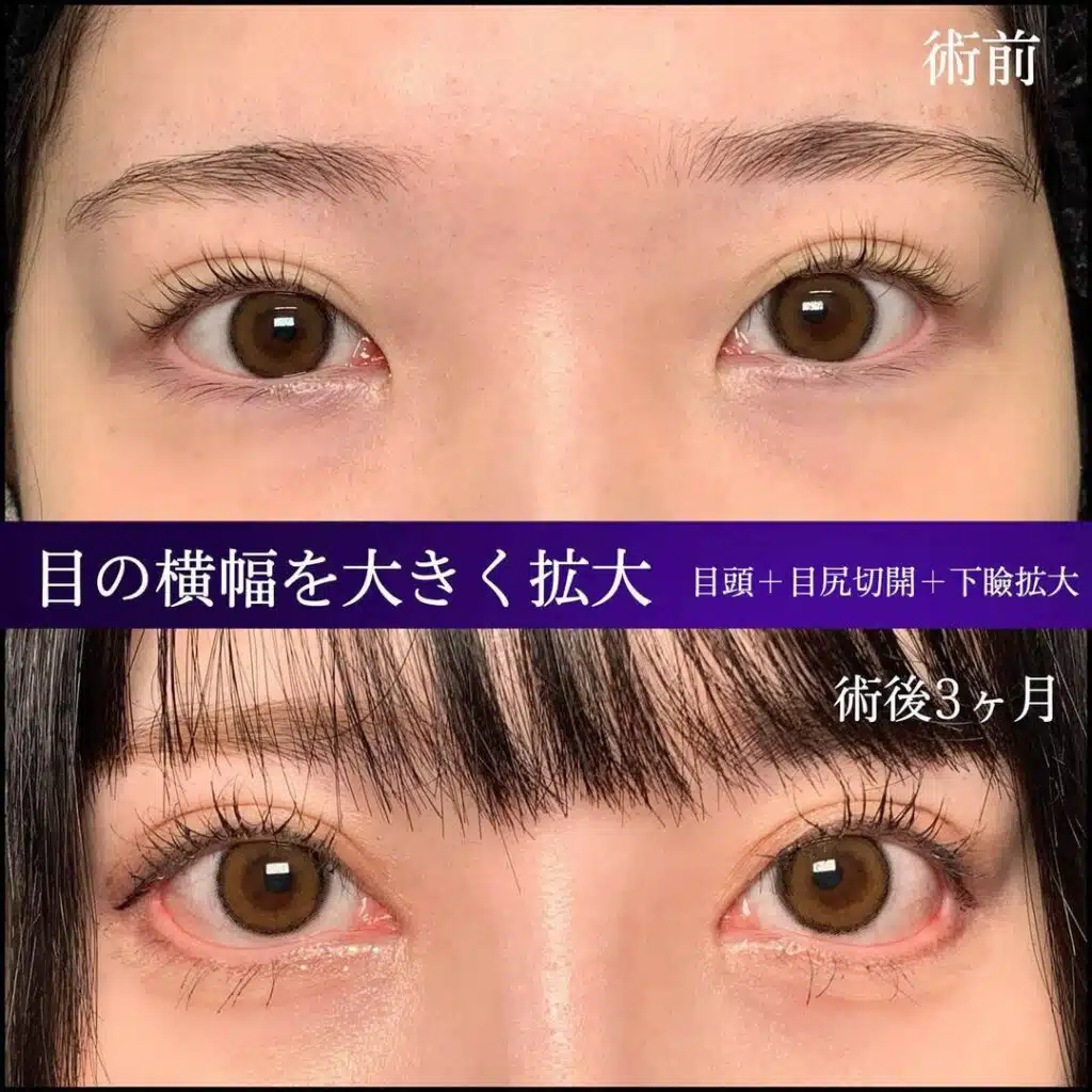 目頭＋目尻切開＋下瞼拡大　福岡