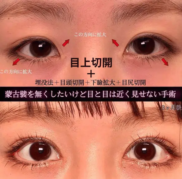 目上切開+埋没法+目頭切開+下瞼拡大+目尻切開　福岡