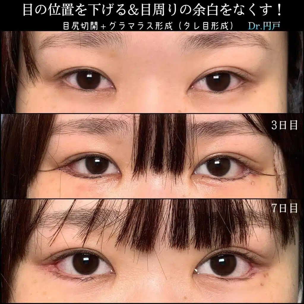 目尻切開+グラマラス形成(タレ目形成) 福岡