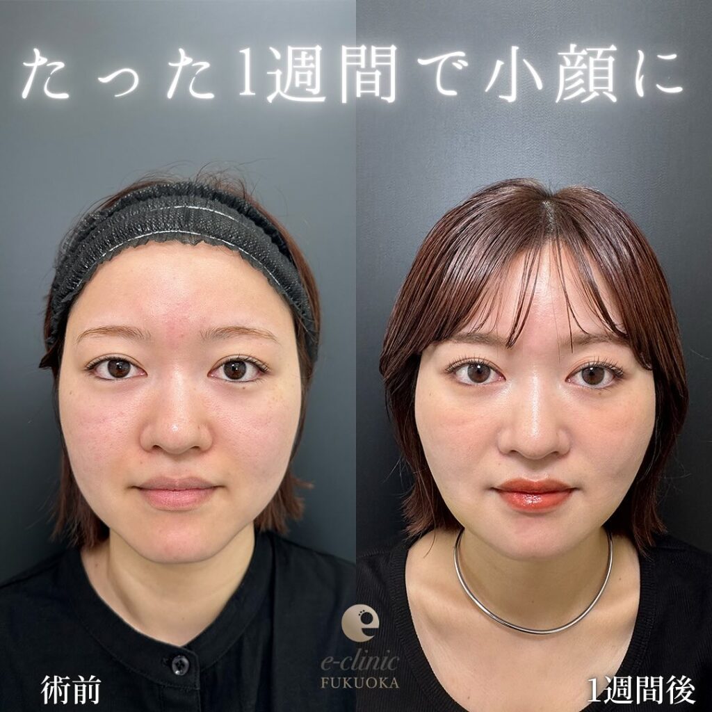 小顔脂肪吸引とジョールファットと糸リフトの症例写真 (5)