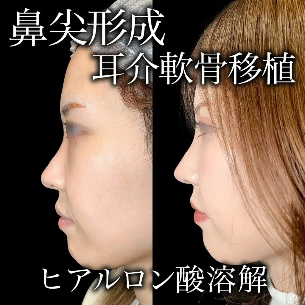 鼻尖形成と耳介軟骨移植 福岡
