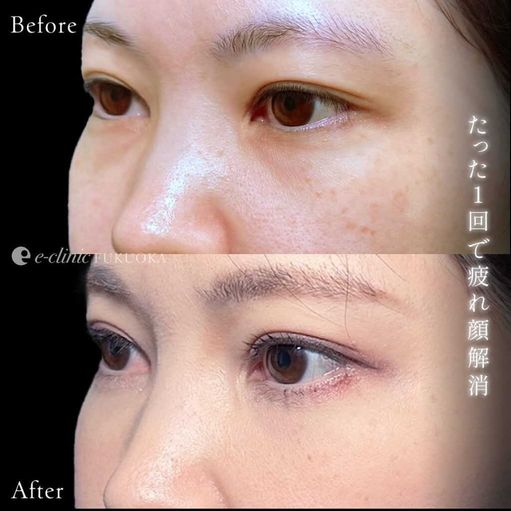 裏ハムラ法と脂肪注入の症例写真 (2)