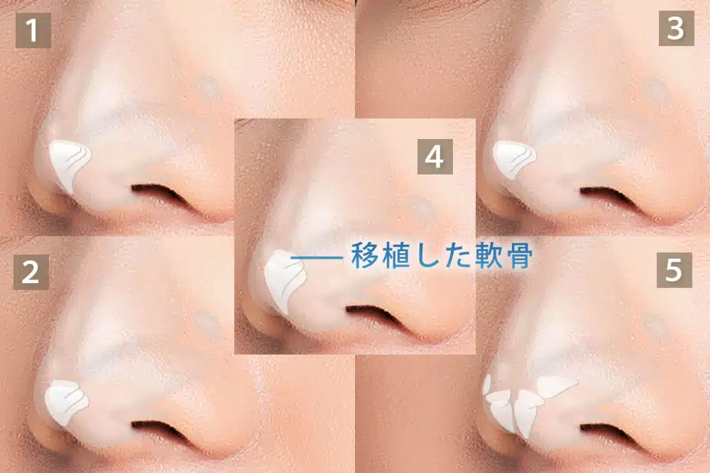 鼻尖軟骨移植の5つのパターン 福岡