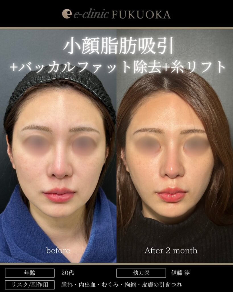 小顔脂肪吸引とジョールファットとバッカルファットと糸リフトの症例写真 (1)