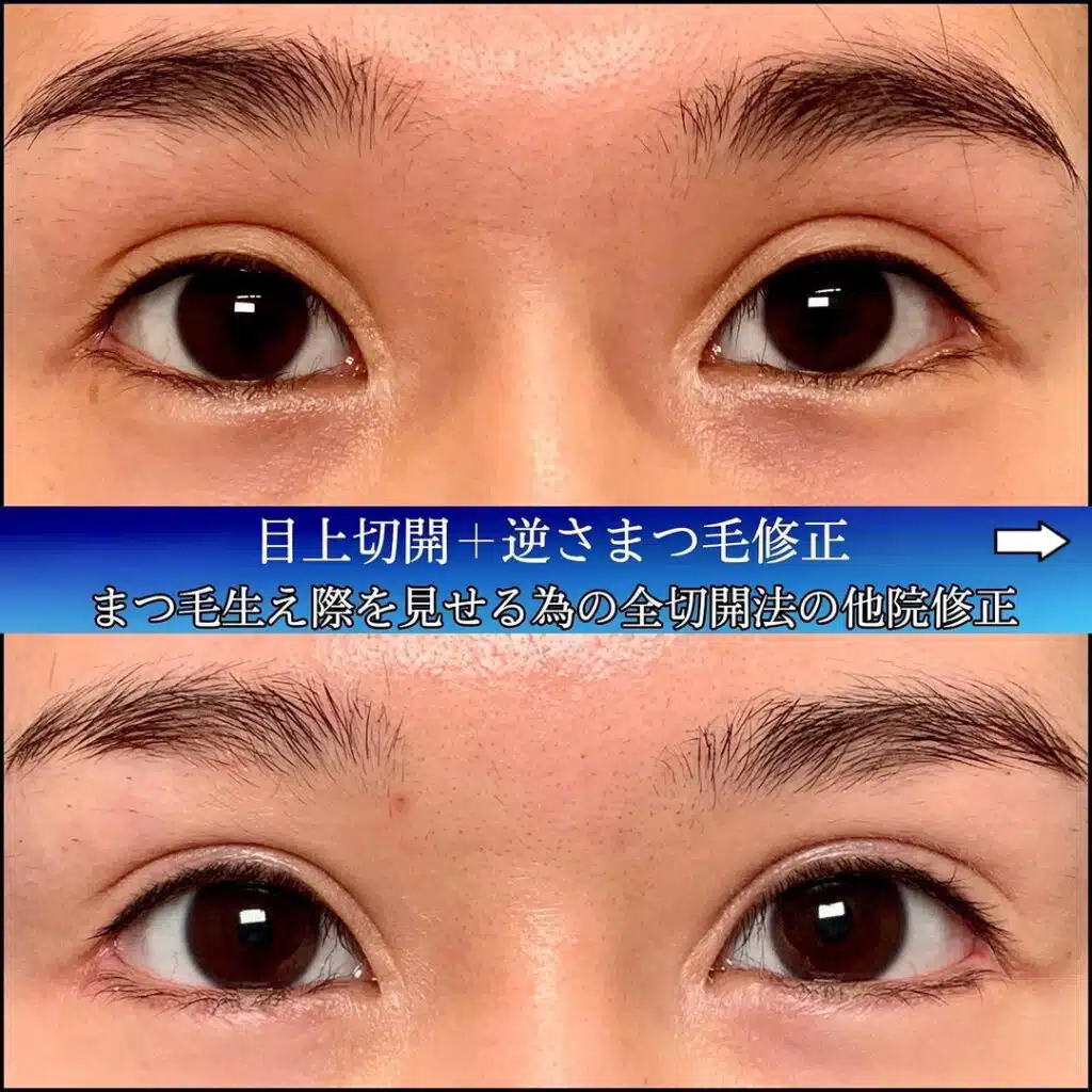 目上切開+逆さまつ毛修正　福岡
