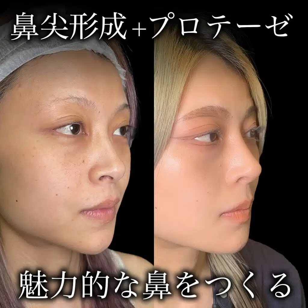 鼻尖形成+プロテーゼ 福岡