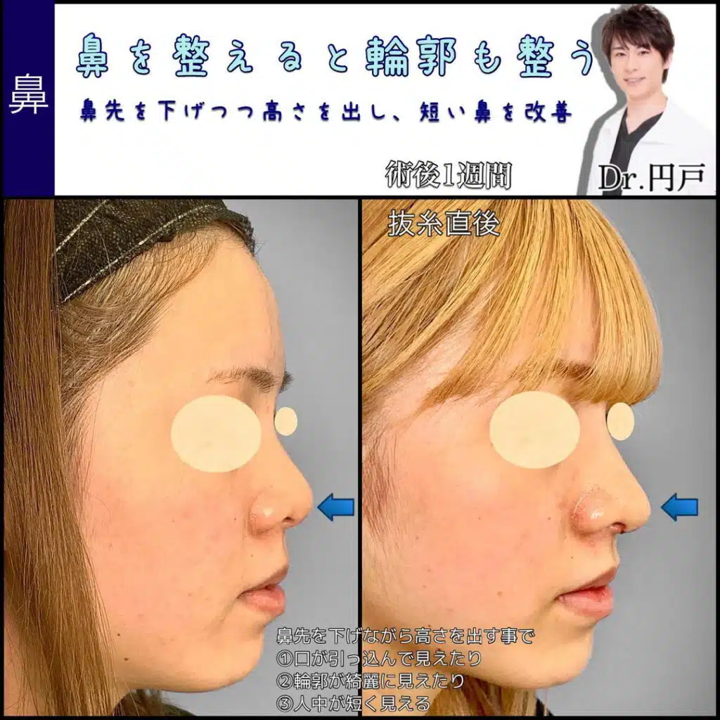 鼻尖形成と鼻中隔延長と軟骨移植 福岡