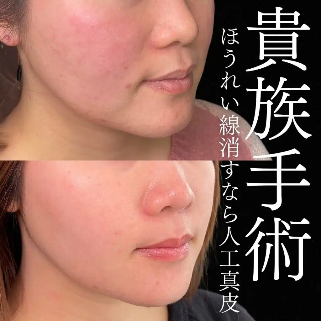 貴族手術 福岡