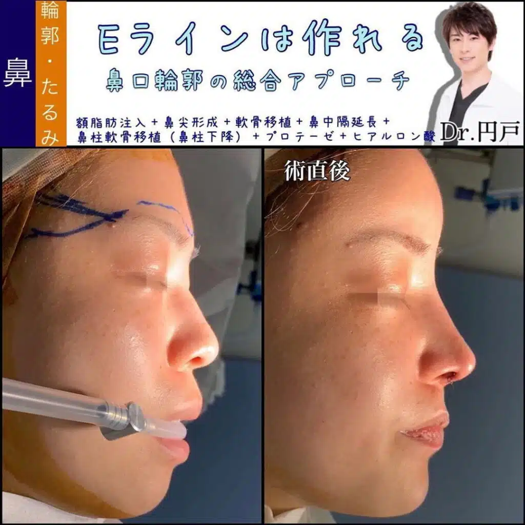 額脂肪注入+鼻尖形成+軟骨移植+鼻柱軟骨移植(鼻柱下降)+プロテーゼ+ヒアルロン酸 福岡