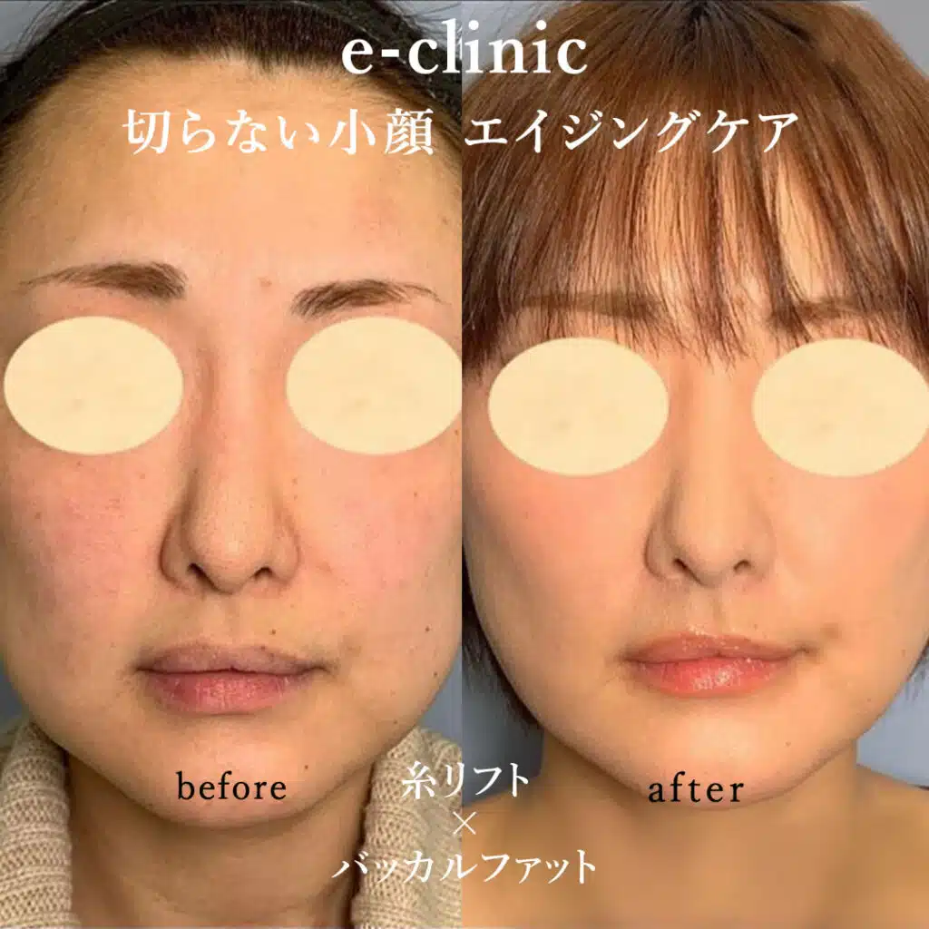 切らない小顔 エイジングケア 糸リフト×バッカルファット 福岡