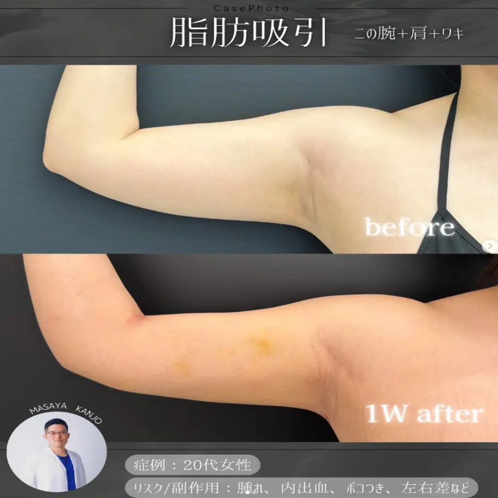 脂肪吸引 二の腕+肩+ワキ 福岡