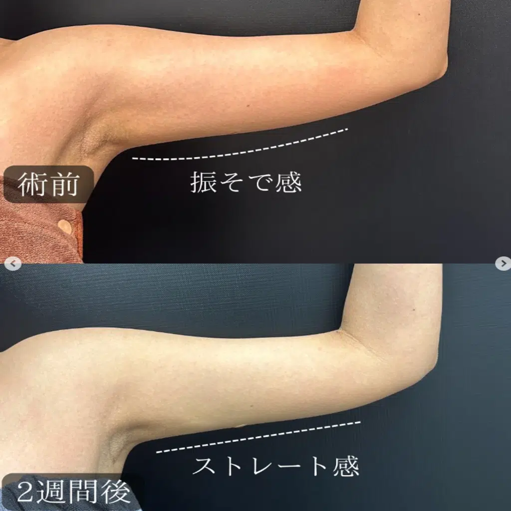 二の腕の脂肪吸引 福岡