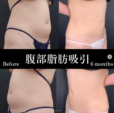 腹部脂肪吸引 福岡