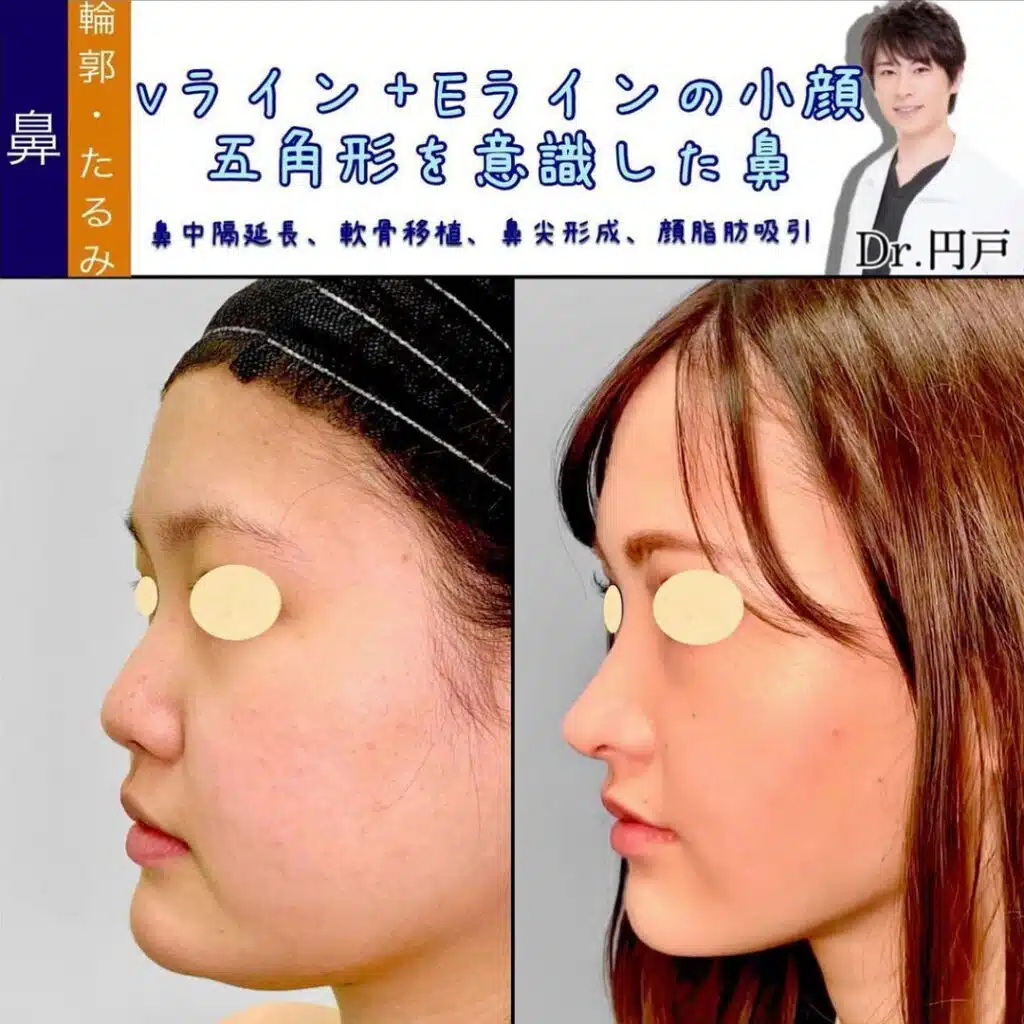 鼻中隔延長、軟骨移植、鼻尖形成、顔脂肪吸引　福岡