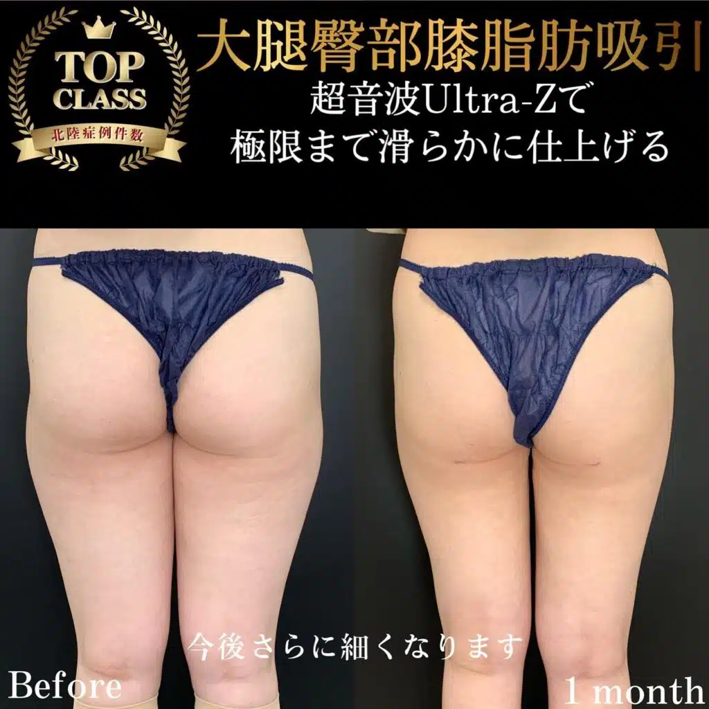 大腿臀部膝脂肪吸引　福岡