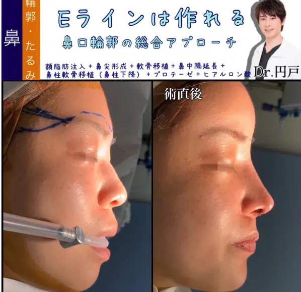 額脂肪注入+鼻尖形成+軟骨移植+鼻中隔延長+鼻柱軟骨移植（鼻柱下降）+プロテーゼ+ヒアルロン酸　福岡
