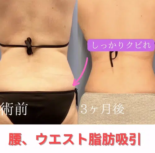 腰、ウエスト脂肪吸引　福岡
