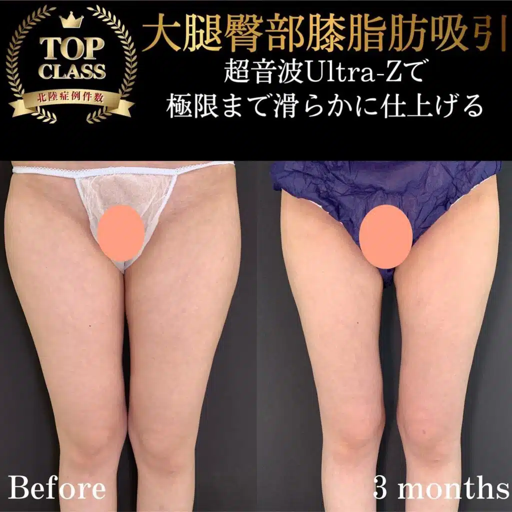大腿臀部膝脂肪吸引　福岡