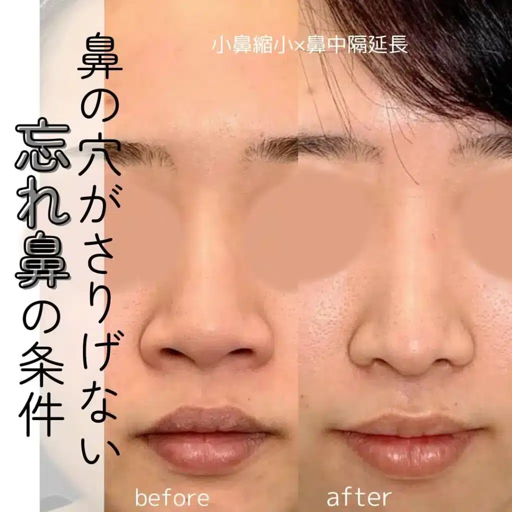 小鼻縮小×鼻中隔延長　福岡