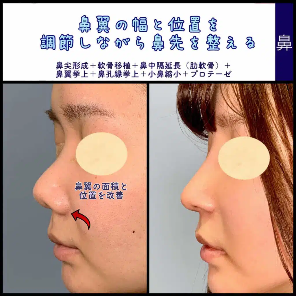 鼻尖形成+軟骨移植+鼻中隔延長（肋軟骨）+鼻翼挙上+鼻孔縁挙上+小鼻縮小+プロテーゼ　福岡