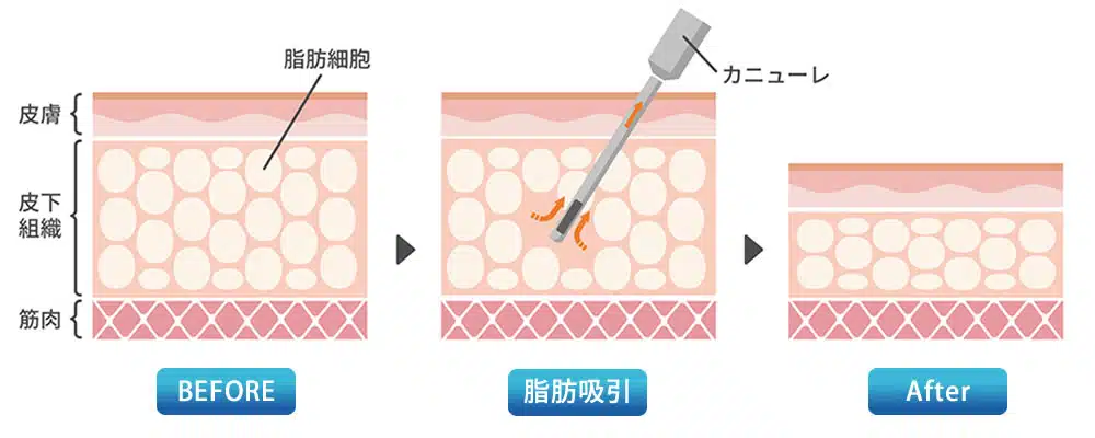脂肪吸引　図解　福岡